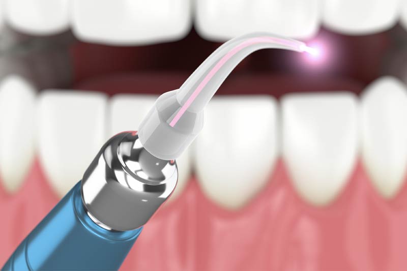Laser Dentistry in Cypress
